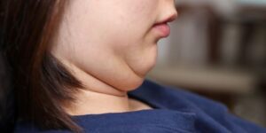 Double Chin Bikin Sebal Karena Mengganggu Penampilan