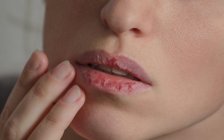 Tips Mengatasi Bibir Kering Serta Faktor Penyebabnya