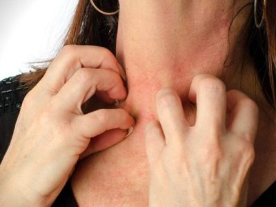 Gejala Penyakit Eksim Cara Mencegah Dan Pengobatannyaa