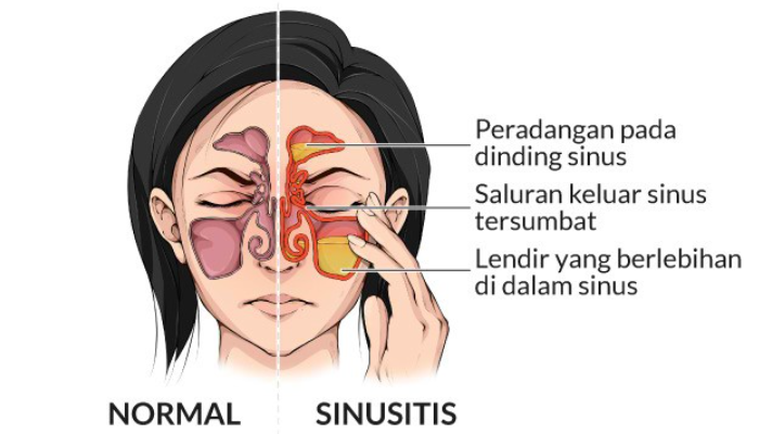 Penyakit Sinusitis Bukan Suatu Penyakit Turunan, Apa Penyebab?