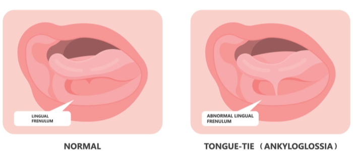 Ankyloglossia Menyebabkan Anak Susah Mengunyah Loh!