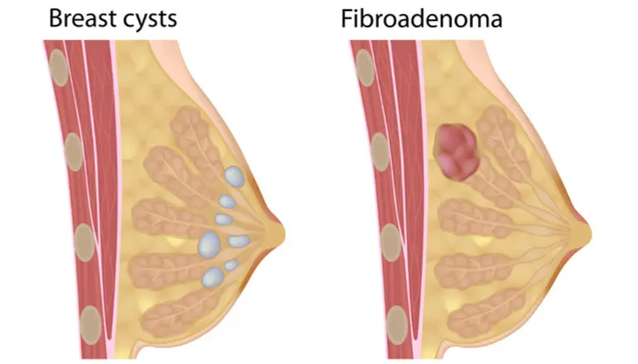 Fibroadenoma Mammae Berbeda Dengan Kanker Payudara