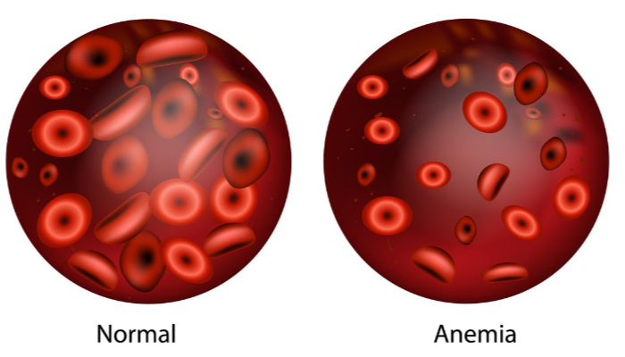 Penyakit Anemia Dapat Di Cegah Dengan Buah Mengkudu Loh!