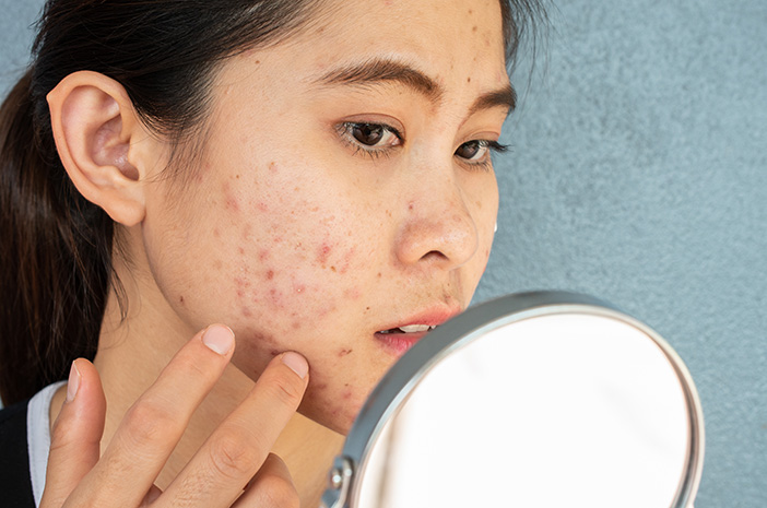 Hilangkan Bekas Jerawat Membandel Dengan Bahan Skincare Ini