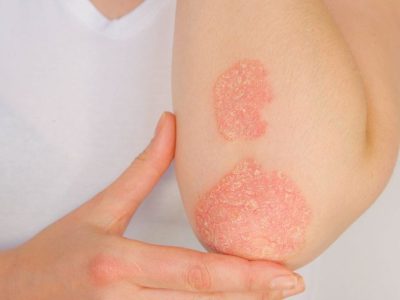Psoriasis