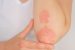 Psoriasis
