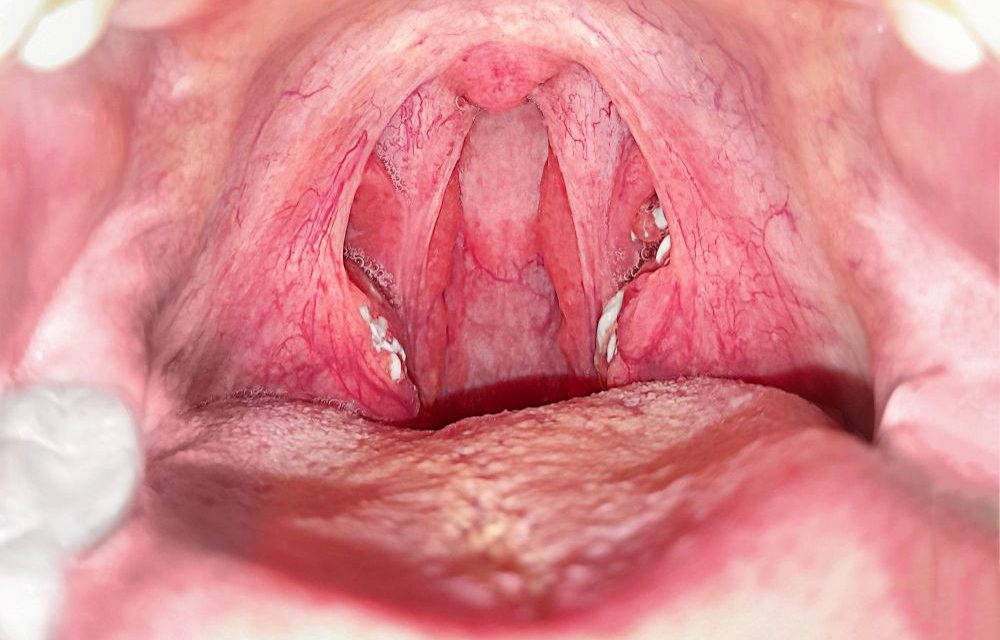 Batu Amandel, Kelenjar Pada Bagian Belakang Tenggorokan