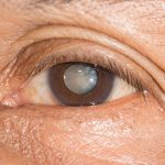 Penyakit Glaukoma, yang Bisa Menyebabkan Kebutaan Mata