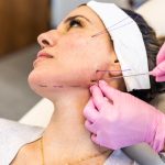 Thread Lift Jadi Trend Dalam Dunia Kecantikan Terkini
